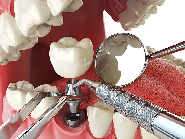 Best Emergency Root Canal Treatment in Suncrest, WA